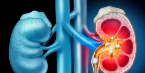 肾结石能吃黑瓜吗女性怎么吃,肾结石患者女性食用黑瓜的适宜方法与注意事项